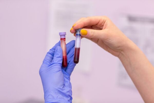 Serum Iron