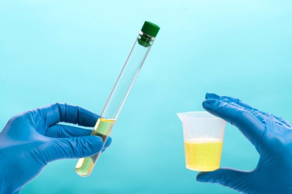 Uric Acid